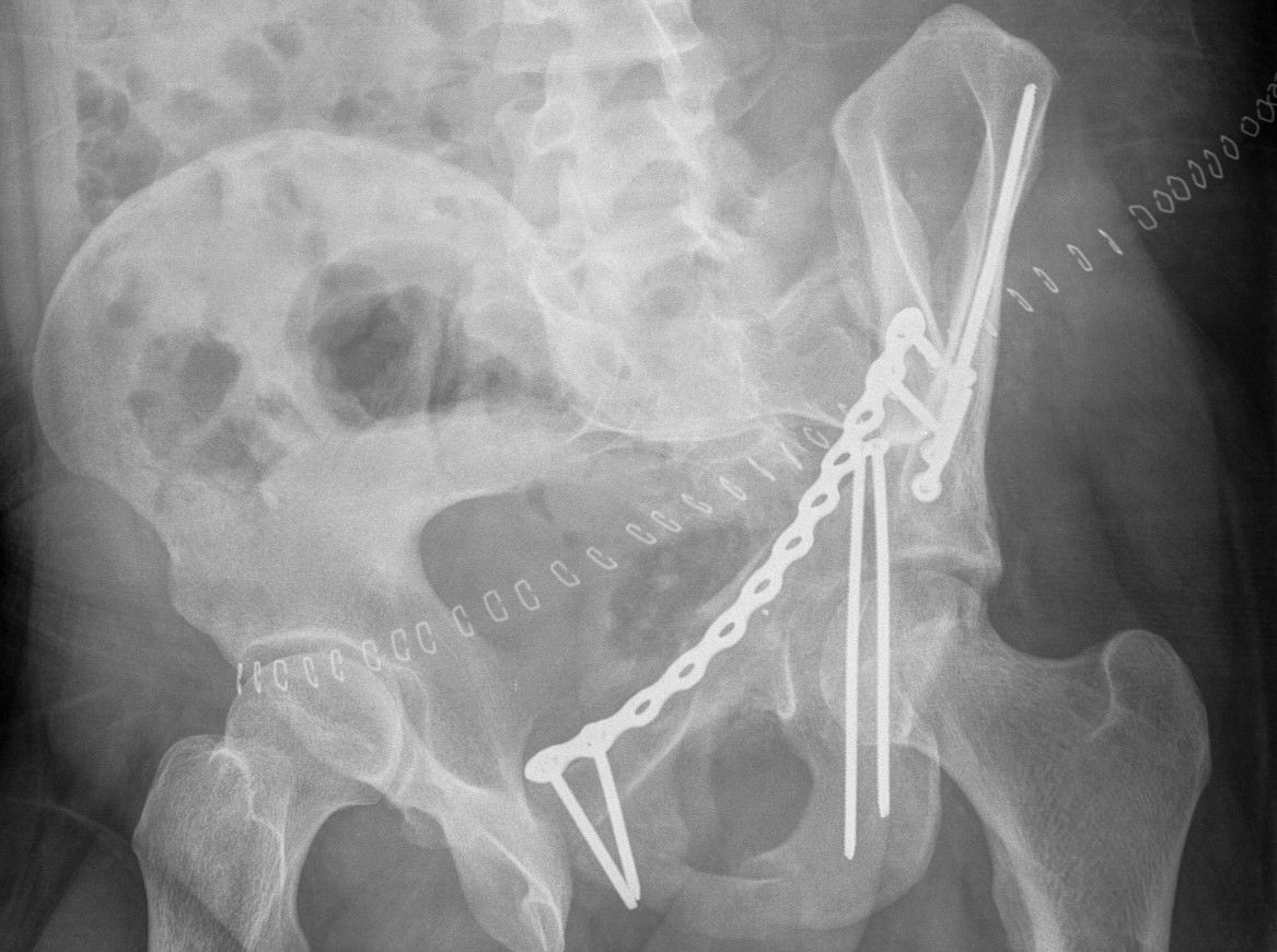 Acetabular ORIF 2 Column Judet 2